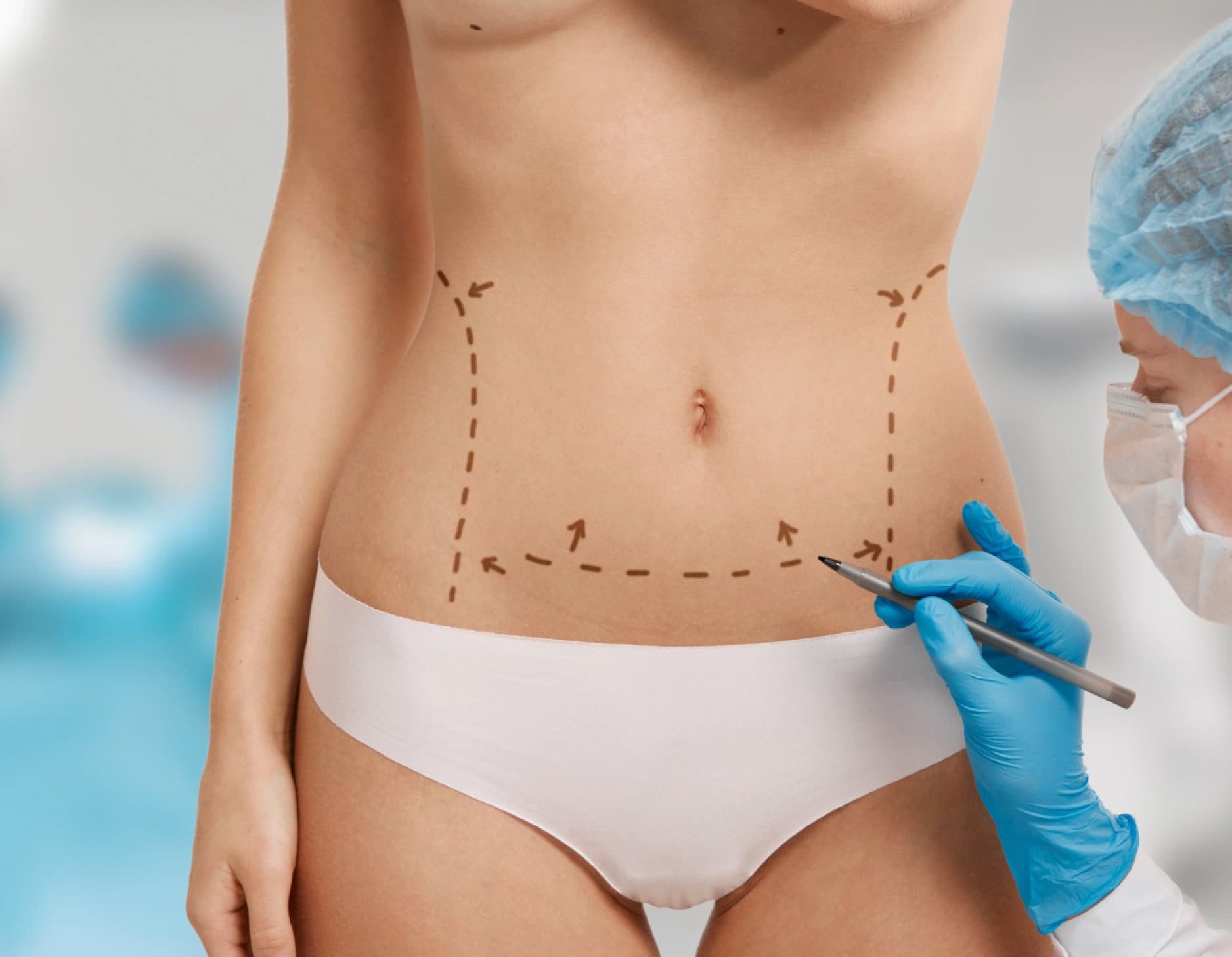 Abdominoplastia (Dermolipectomía) — imagen 1