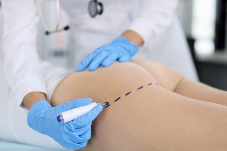 Gluteoplastia con Implantes — imagen 1