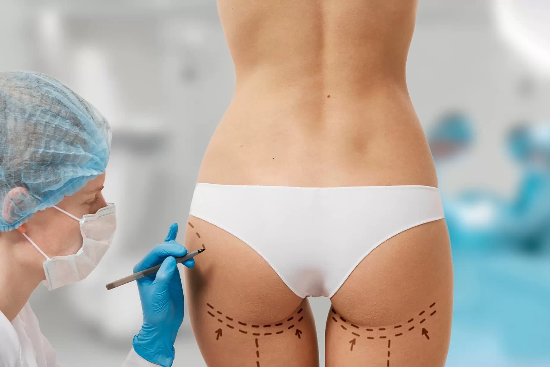 Gluteoplastia con Implantes — imagen 3