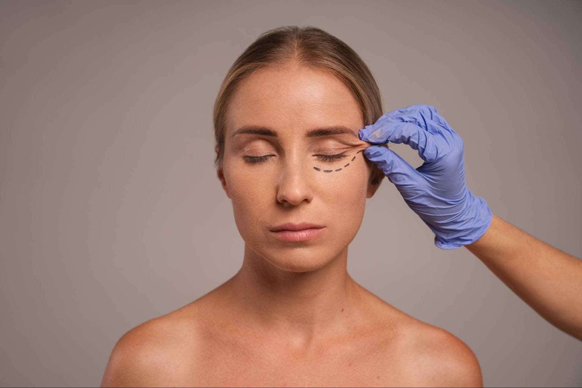 Blefaroplastia — imagen 1