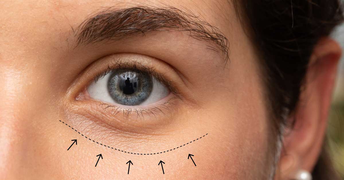 Blefaroplastia — imagen 2