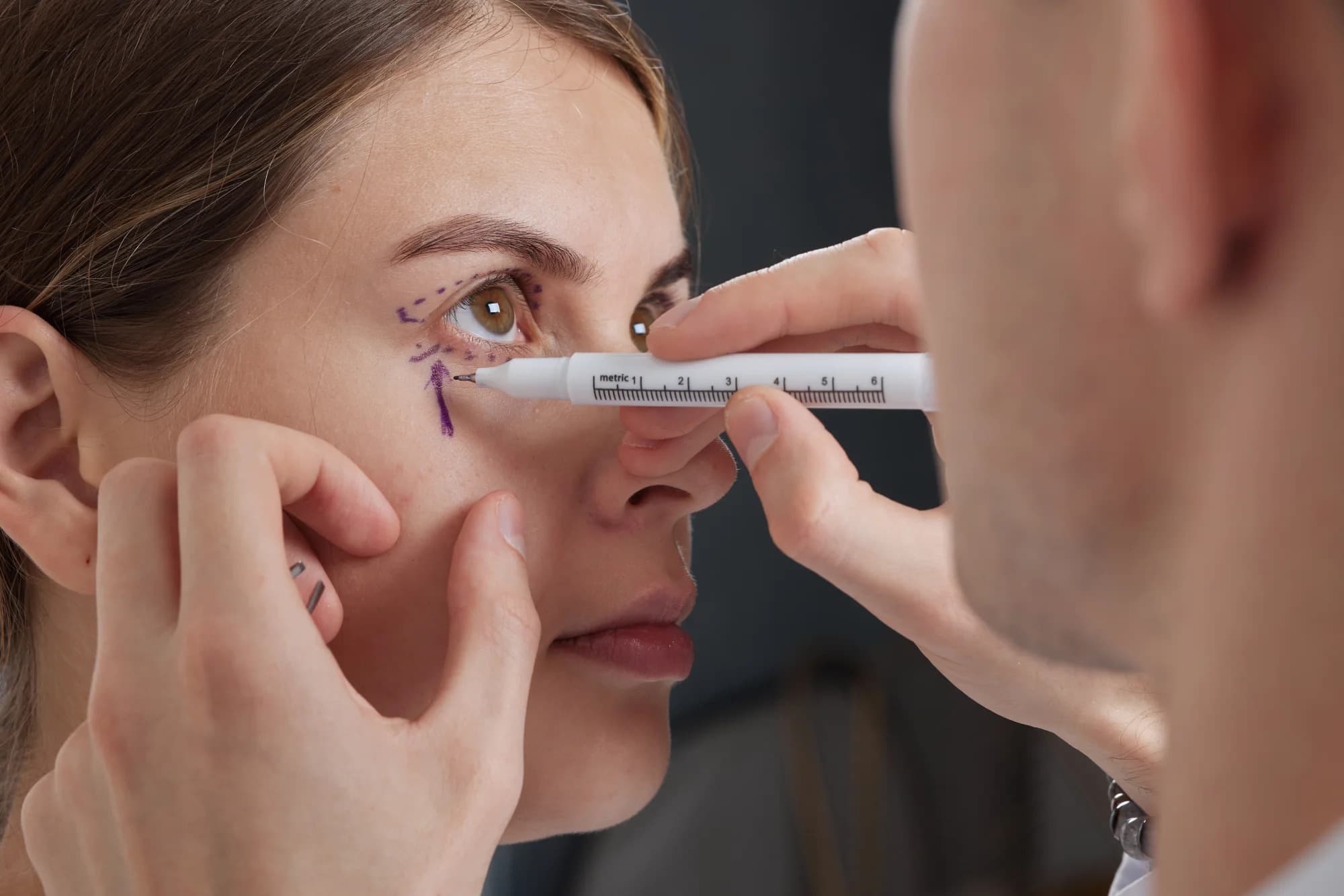 Blefaroplastia — imagen 3