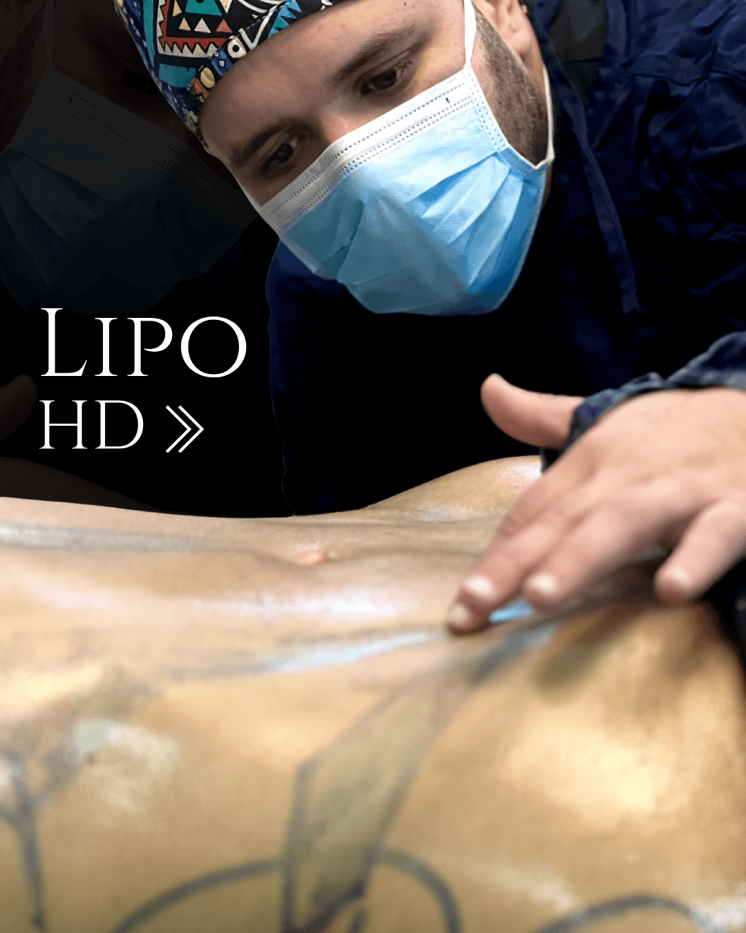 Liposucción HD — imagen 1