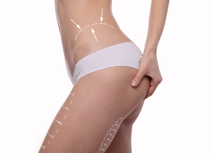 Lipotransferencia (BBL) — imagen 1