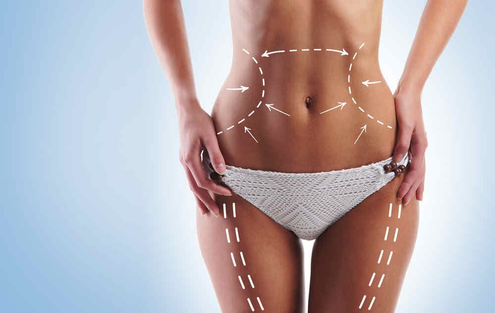 Lipotransferencia (BBL) — imagen 2