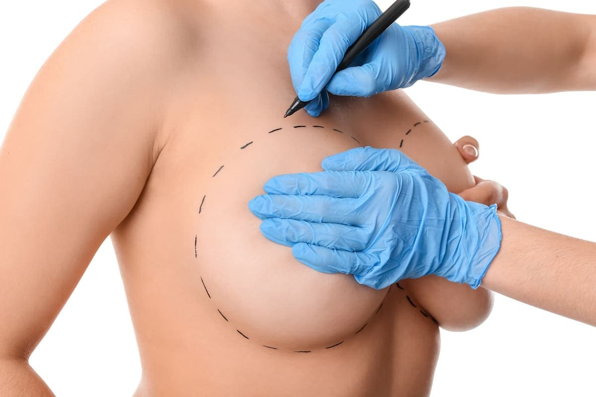 Mamoplastia con Implante — imagen 1