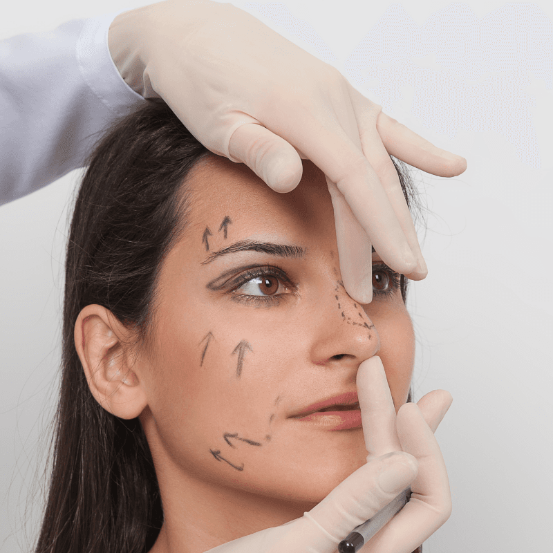 Rinoplastia — imagen 16
