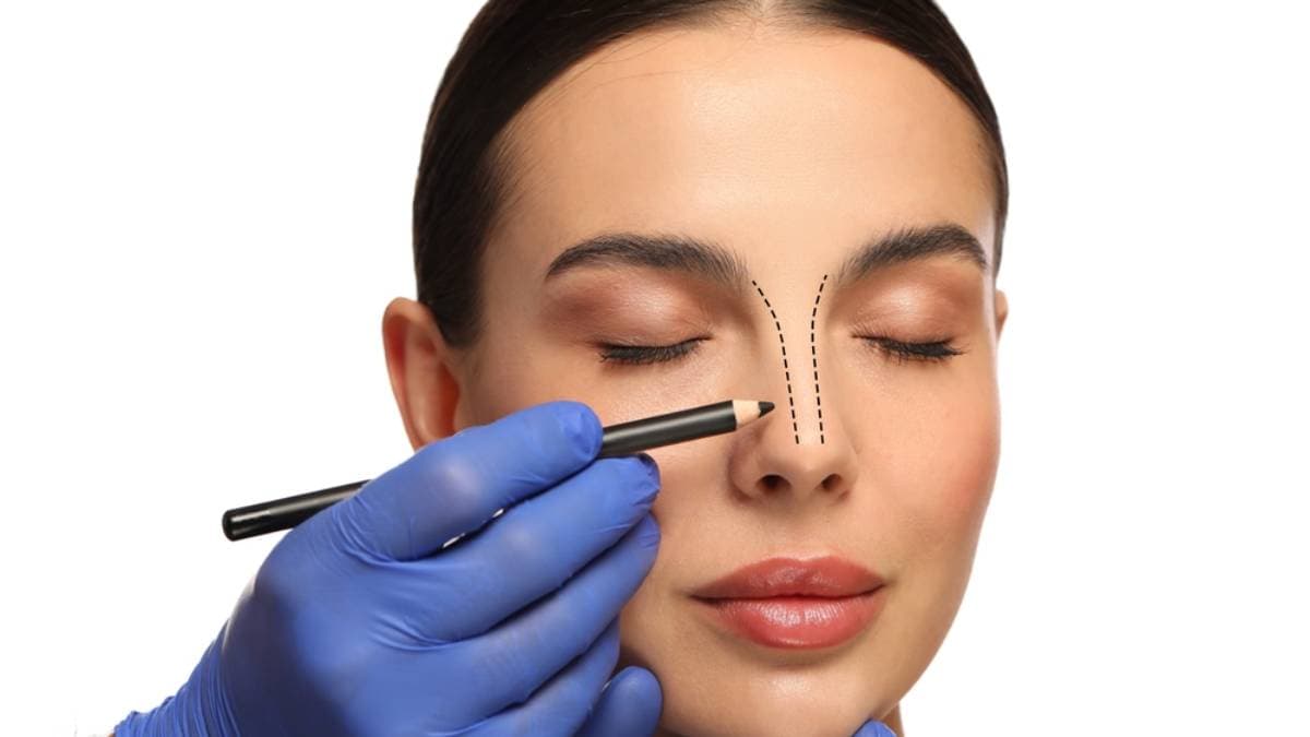 Rinoplastia — imagen 17