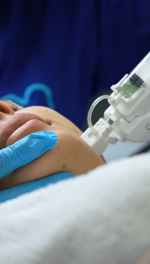 Microneedling